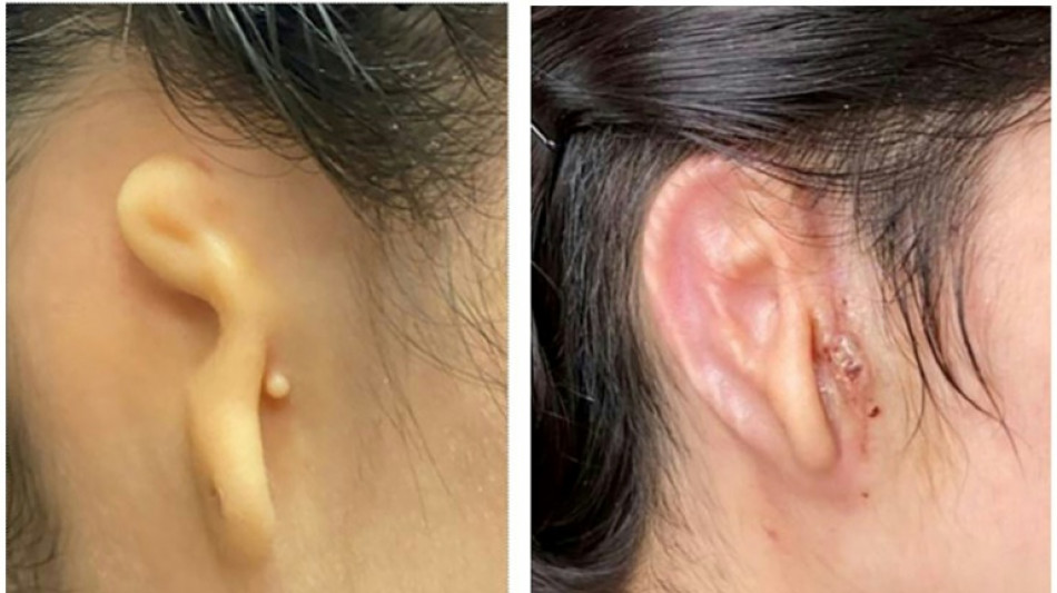 Cirujano implanta en paciente oreja impresa a partir de c&eacute;lulas humanas