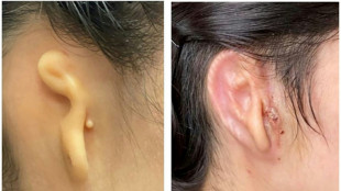 Cirujano implanta en paciente oreja impresa a partir de c&eacute;lulas humanas