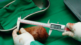Extirpan a un paciente en Sri Lanka el "c&aacute;lculo renal m&aacute;s grande del mundo"